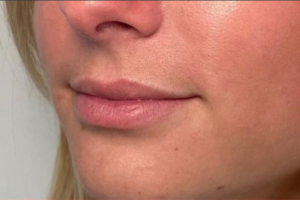 Lip Fillers Before & After Image