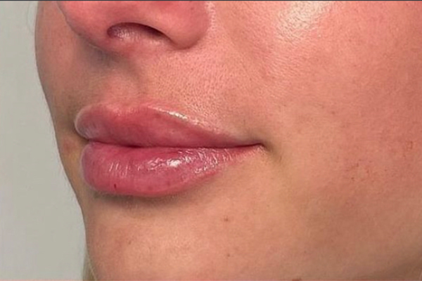 Lip Fillers Before & After Image