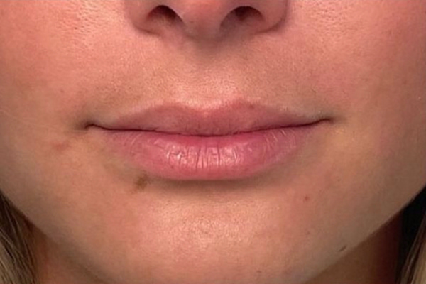 Lip Fillers Before & After Image