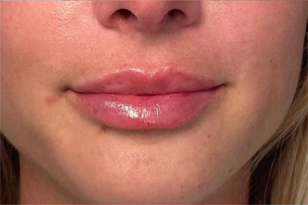 Lip Fillers Before & After Image