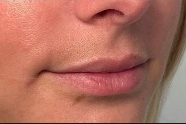 Lip Fillers Before & After Image