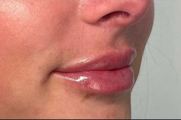 Lip Fillers Before & After Image