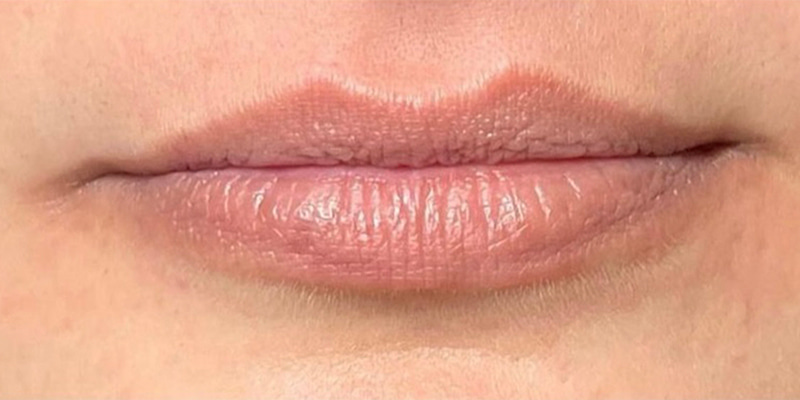 Lip Fillers Before & After Image