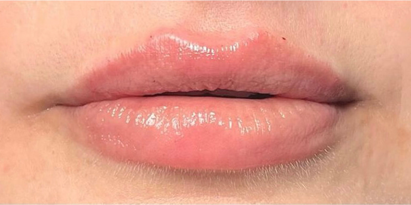 Lip Fillers Before & After Image