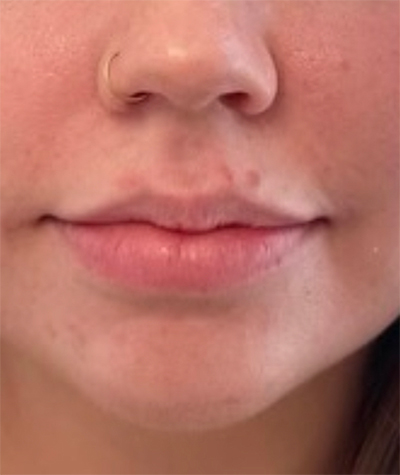 Lip Fillers Before & After Image