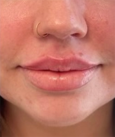 Lip Fillers Before & After Image