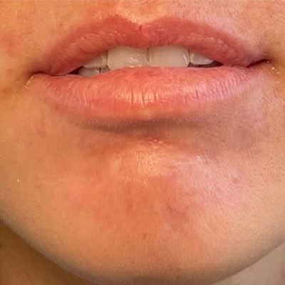 Lip Fillers Before & After Image