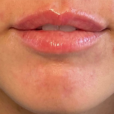 Lip Fillers Before & After Image