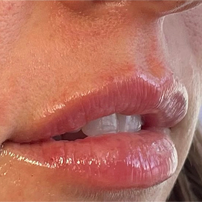 Lip Fillers Before & After Image