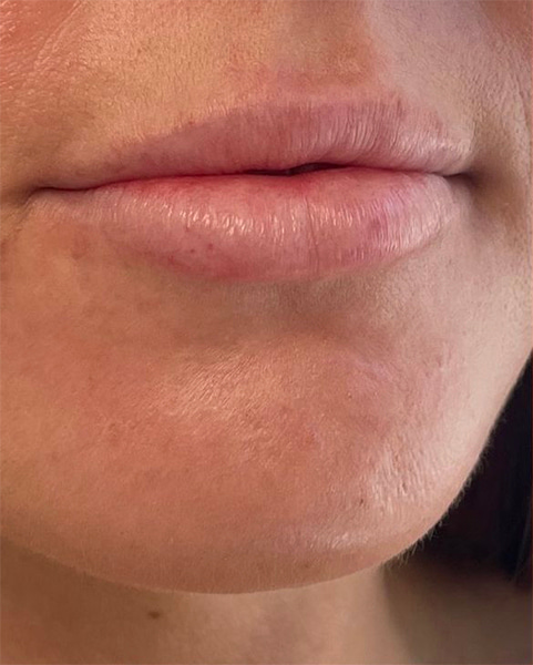 Lip Fillers Before & After Image