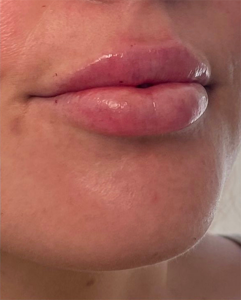 Lip Fillers Before & After Image