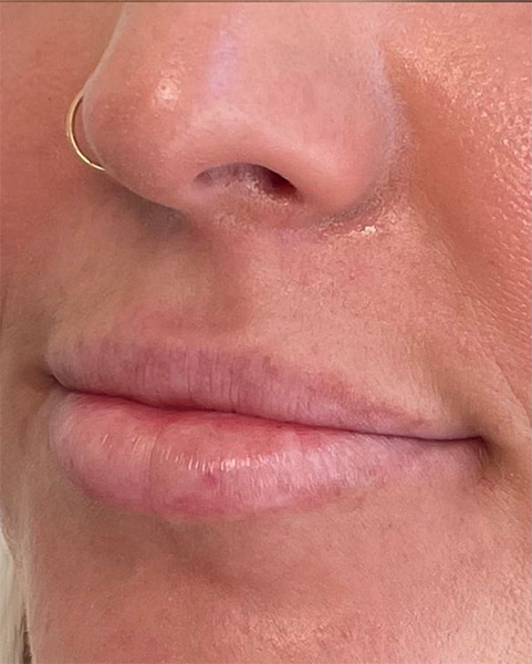 Lip Fillers Before & After Image