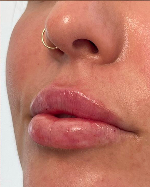 Lip Fillers Before & After Image