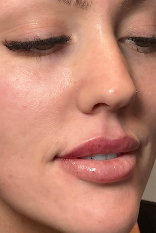 Lip Fillers Before & After Image