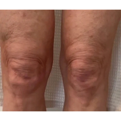 Haus-of-Marin-Laser-Treatments-Patient-one-Before-image