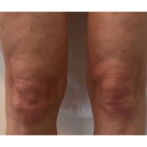 Haus-of-Marin-Laser-Treatments-Patient-one-aftre-image