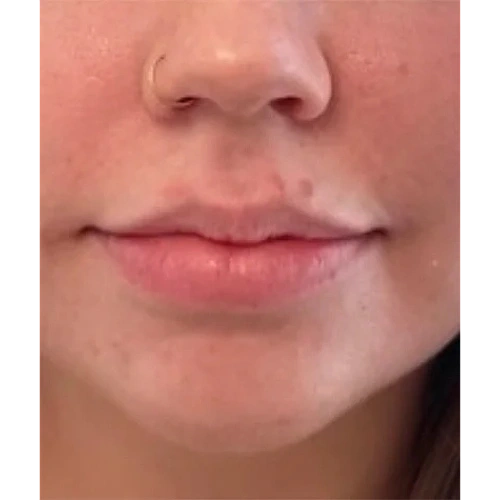 Haus-of-Marin-Lip-filler-Patient-five-after-image