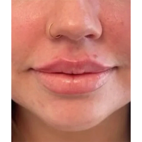 Haus-of-Marin-Lip-filler-Patient-five-before-image
