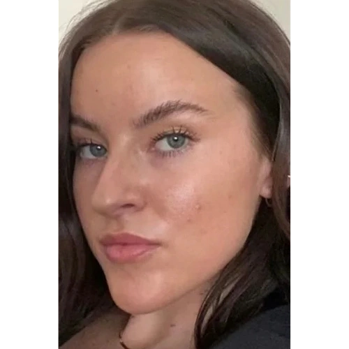 Haus-of-Marin-Lip-filler-Patient-four-before-image