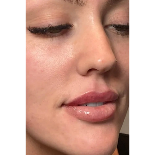 Haus-of-Marin-Lip-filler-Patient-one-After-image