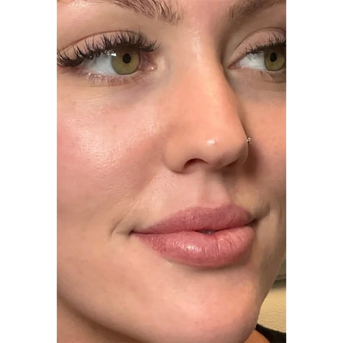 Haus-of-Marin-Lip-filler-Patient-one-before-image