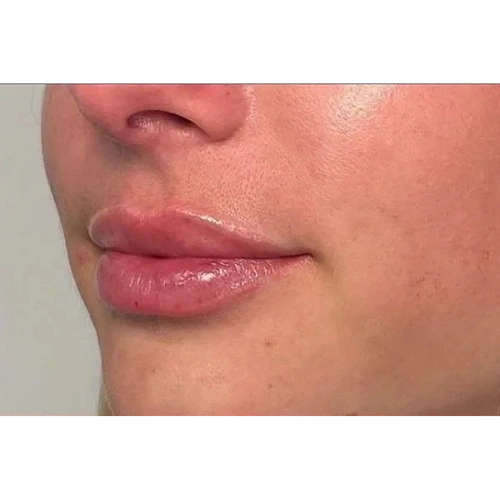 Haus-of-Marin-Lip-filler-Patient-seven-after-image-one