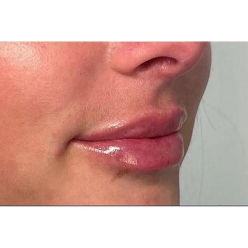 Haus-of-Marin-Lip-filler-Patient-seven-after-image-three