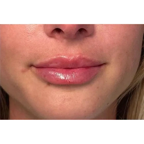 Haus-of-Marin-Lip-filler-Patient-seven-after-image-two