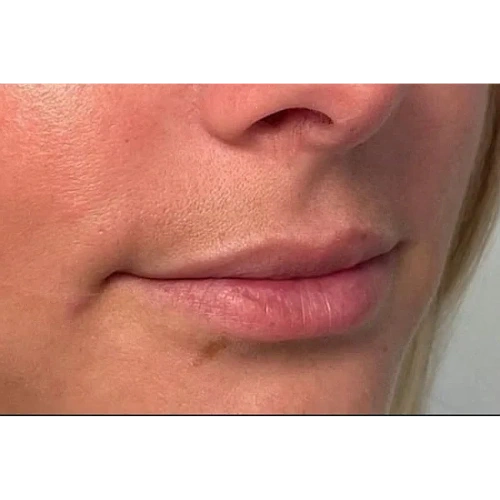 Haus-of-Marin-Lip-filler-Patient-seven-before-image-three