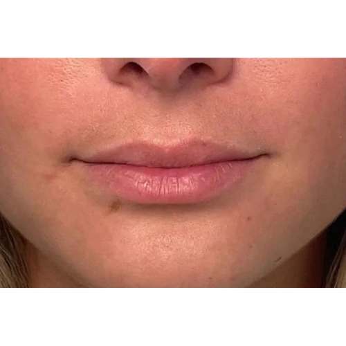 Haus-of-Marin-Lip-filler-Patient-seven-before-image-two