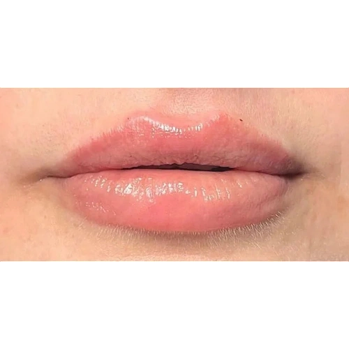 Haus-of-Marin-Lip-filler-Patient-six-after-image