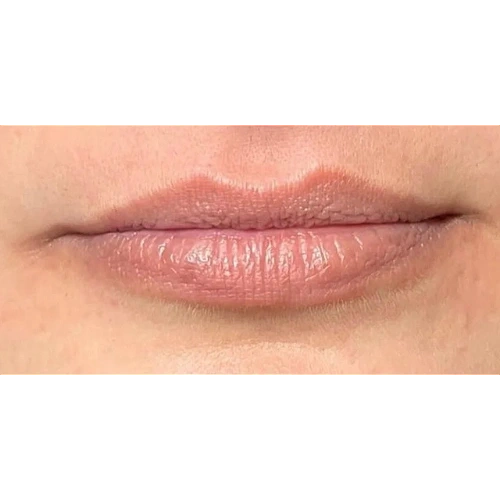 Haus-of-Marin-Lip-filler-Patient-six-before-image