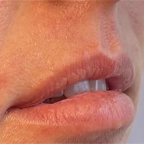 Haus-of-Marin-Lip-filler-Patient-three-after-image-Two