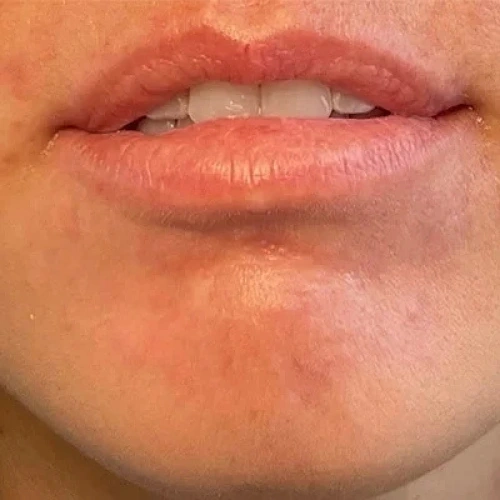 Haus-of-Marin-Lip-filler-Patient-three-before-image-one