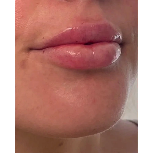 Haus-of-Marin-Lip-filler-Patient-two-after-image-one
