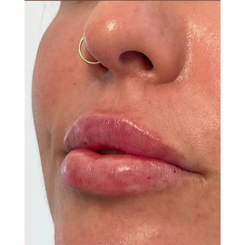 Haus-of-Marin-Lip-filler-Patient-two-after-image-two