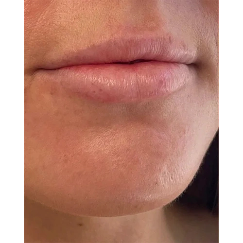 Haus-of-Marin-Lip-filler-Patient-two-before-image-one