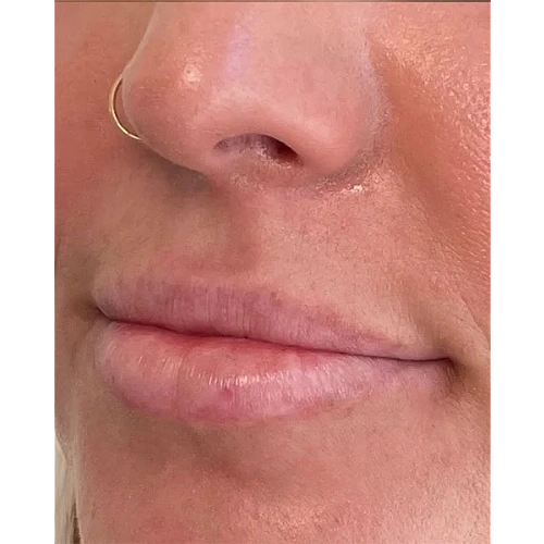Haus-of-Marin-Lip-filler-Patient-two-before-image-two