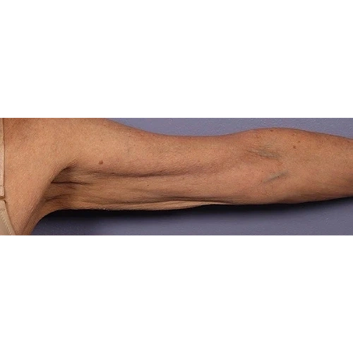 Haus-of-Marin-Morpheus8-Patient-one-Before-image