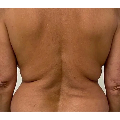 Haus-of-Marin-Morpheus8-Patient-three-Before-image