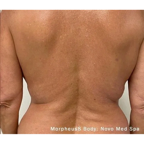 Haus-of-Marin-Morpheus8-Patient-three-after-image