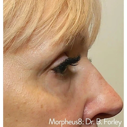 Haus-of-Marin-Morpheus8-Patient-two-after-image